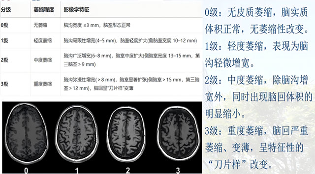 健忘、迷路、认错人,到底是不是“老年痴呆”?做这项检查就能揪出元凶(图5) 认不出时间