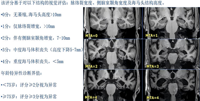 健忘、迷路、认错人,到底是不是“老年痴呆”?做这项检查就能揪出元凶(图6) 但换成电子数字